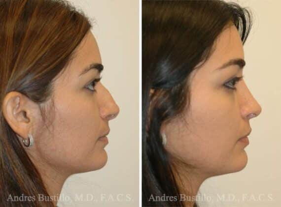 Rhinoplasty Before and After Photos in Miami, FL, Patient 15895