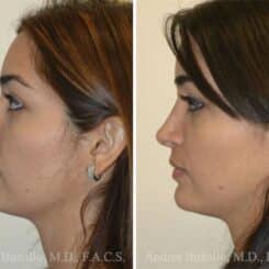 Rhinoplasty Before and After Photos in Miami, FL, Patient 15895