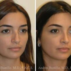 Rhinoplasty Before and After Photos in Miami, FL, Patient 15895