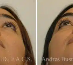 Rhinoplasty Before and After Photos in Miami, FL, Patient 15895