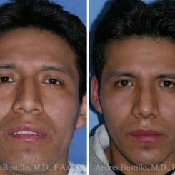 Rhinoplasty Before and After Photos in Miami, FL, Patient 15604