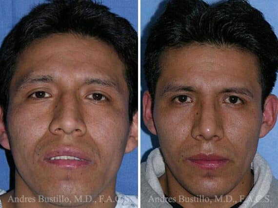 Rhinoplasty Before and After Photos in Miami, FL, Patient 15604