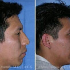 Rhinoplasty Before and After Photos in Miami, FL, Patient 15604