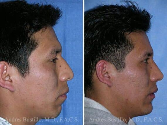 Rhinoplasty Before and After Photos in Miami, FL, Patient 15604