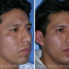 Rhinoplasty Before and After Photos in Miami, FL, Patient 15604