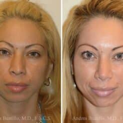 Rhinoplasty Before and After Photos in Miami, FL, Patient 15613