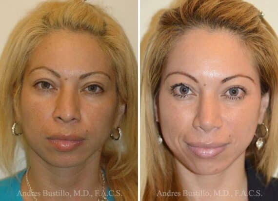 Rhinoplasty Before and After Photos in Miami, FL, Patient 15613