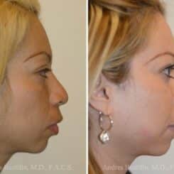 Rhinoplasty Before and After Photos in Miami, FL, Patient 15613