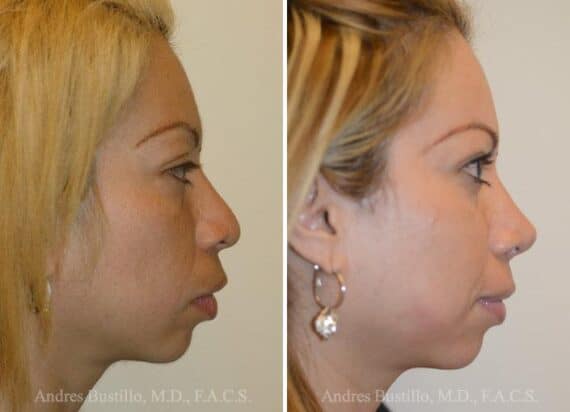 Rhinoplasty Before and After Photos in Miami, FL, Patient 15613