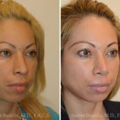 Rhinoplasty Before and After Photos in Miami, FL, Patient 15613