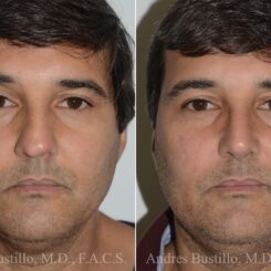 Rhinoplasty Before and After Photos in Miami, FL, Patient 17417