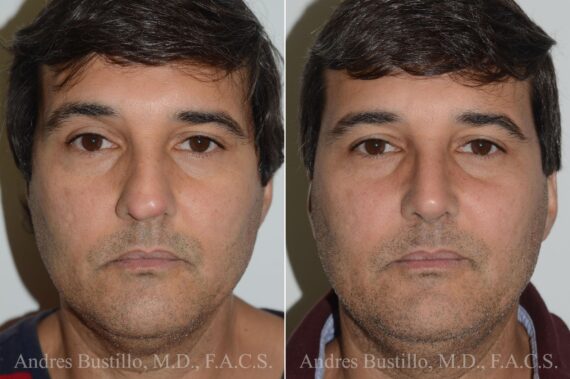 Rhinoplasty Before and After Photos in Miami, FL, Patient 17417