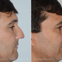 Rhinoplasty Before and After Photos in Miami, FL, Patient 17417