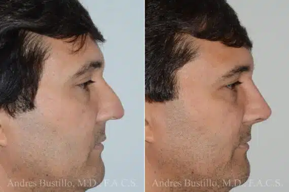 Rhinoplasty Before and After Photos in Miami, FL, Patient 17417