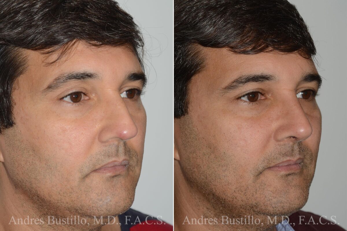 Rhinoplasty Before and After Photos in Miami, FL, Patient 17417
