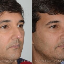 Rhinoplasty Before and After Photos in Miami, FL, Patient 17417