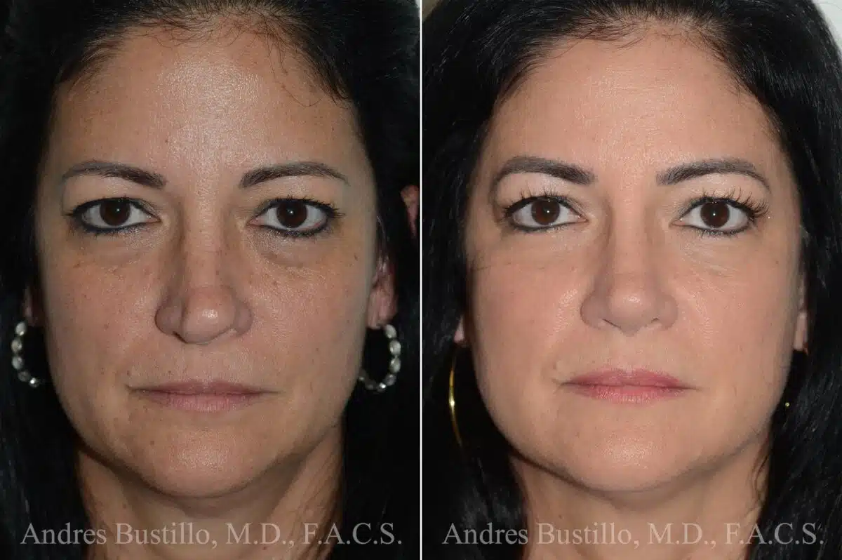 Rhinoplasty Before and After Photos in Miami, FL, Patient 17023