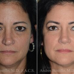 Rhinoplasty Before and After Photos in Miami, FL, Patient 17023