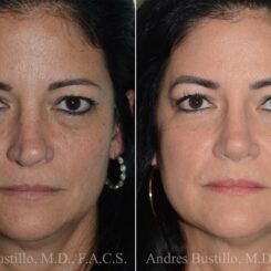 Rhinoplasty Before and After Photos in Miami, FL, Patient 17023