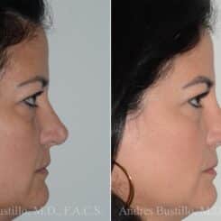 Rhinoplasty Before and After Photos in Miami, FL, Patient 17023