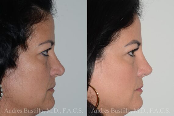 Rhinoplasty Before and After Photos in Miami, FL, Patient 17023