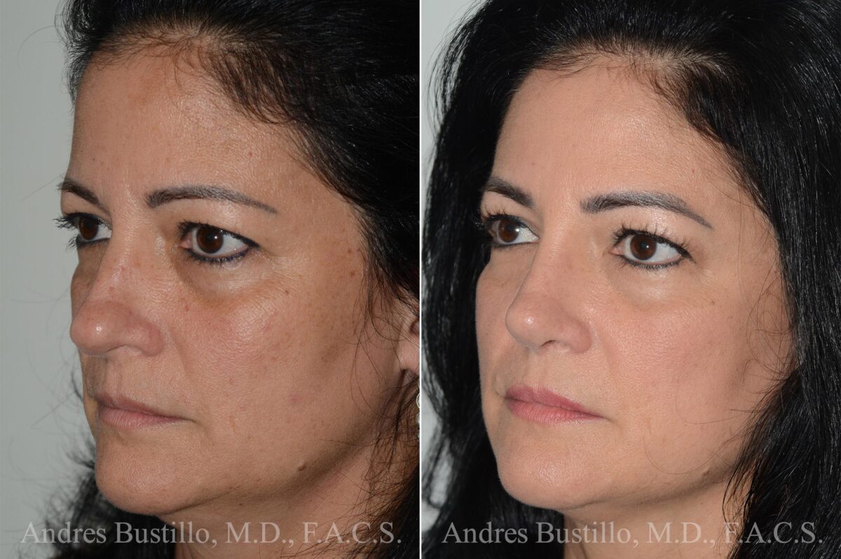 Rhinoplasty Before and After Photos in Miami, FL, Patient 17023