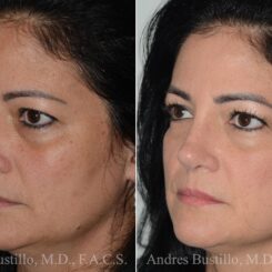 Rhinoplasty Before and After Photos in Miami, FL, Patient 17023