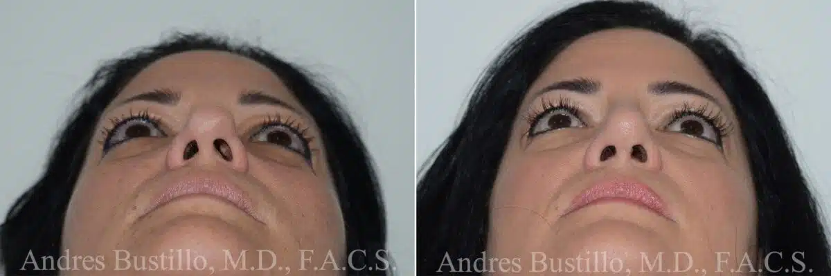 Rhinoplasty Before and After Photos in Miami, FL, Patient 17023