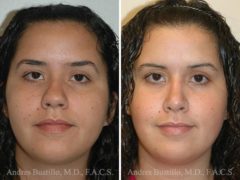 Rhinoplasty Before and After Photos in Miami, FL, Patient 15568