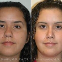 Rhinoplasty Before and After Photos in Miami, FL, Patient 15568