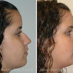 Rhinoplasty Before and After Photos in Miami, FL, Patient 15568