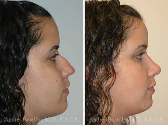 Rhinoplasty Before and After Photos in Miami, FL, Patient 15568