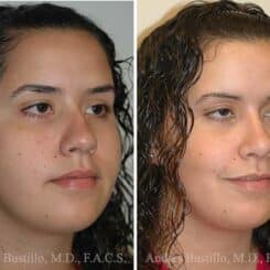 Rhinoplasty Before and After Photos in Miami, FL, Patient 15568