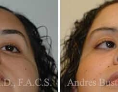 Rhinoplasty Before and After Photos in Miami, FL, Patient 15568