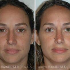 Rhinoplasty Before and After Photos in Miami, FL, Patient 15577