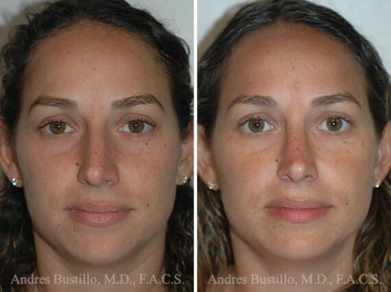 Rhinoplasty Before and After Photos in Miami, FL, Patient 15577