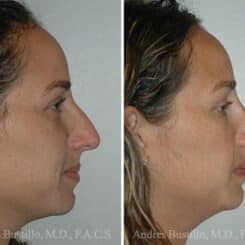 Rhinoplasty Before and After Photos in Miami, FL, Patient 15577