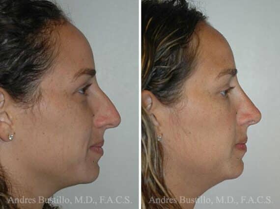 Rhinoplasty Before and After Photos in Miami, FL, Patient 15577