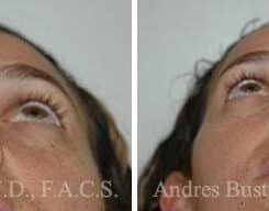 Rhinoplasty Before and After Photos in Miami, FL, Patient 15577