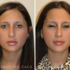 Rhinoplasty Before and After Photos in Miami, FL, Patient 15586