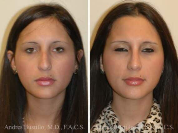 Rhinoplasty Before and After Photos in Miami, FL, Patient 15586