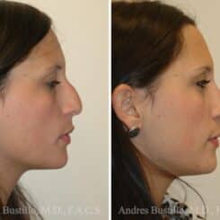 Rhinoplasty Before and After Photos in Miami, FL, Patient 15586