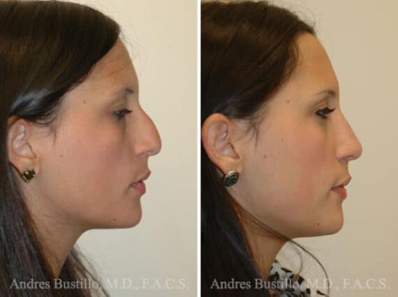 Rhinoplasty Before and After Photos in Miami, FL, Patient 15586