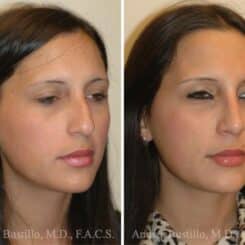 Rhinoplasty Before and After Photos in Miami, FL, Patient 15586