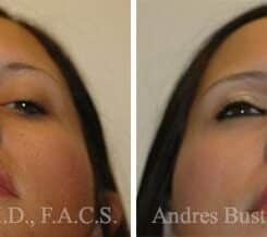 Rhinoplasty Before and After Photos in Miami, FL, Patient 15586