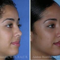 Revision Rhinoplasty Before and After Photos in Miami, FL, Patient 15629