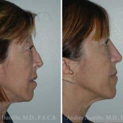 Revision Rhinoplasty Before and After Photos in Miami, FL, Patient 15638