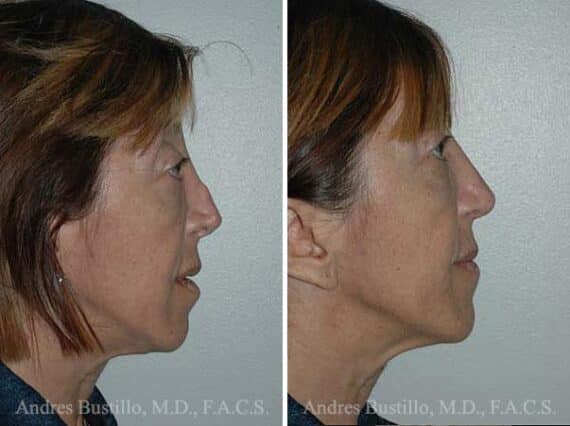 Revision Rhinoplasty Before and After Photos in Miami, FL, Patient 15638