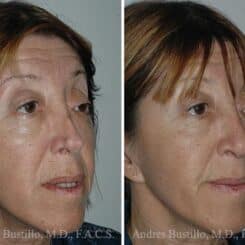 Revision Rhinoplasty Before and After Photos in Miami, FL, Patient 15638