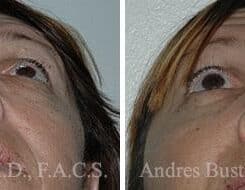 Revision Rhinoplasty Before and After Photos in Miami, FL, Patient 15638